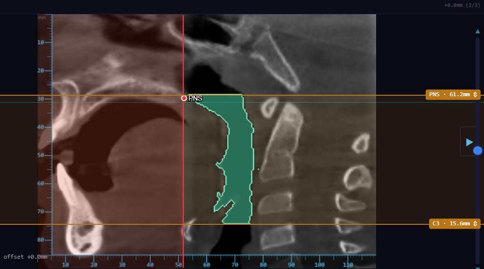 Análisis CBCT de vía aérea en Klinafy